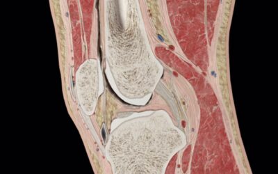 Störningar i patellofemoralleden